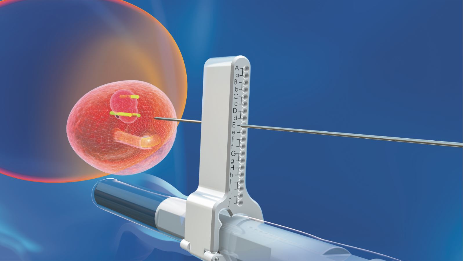 MRT/Ultraschall Fusionsbiopsie der Prostata - Asklepios Stadtklinik Bad ...